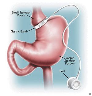 gastric banding laparoscopic bariatric