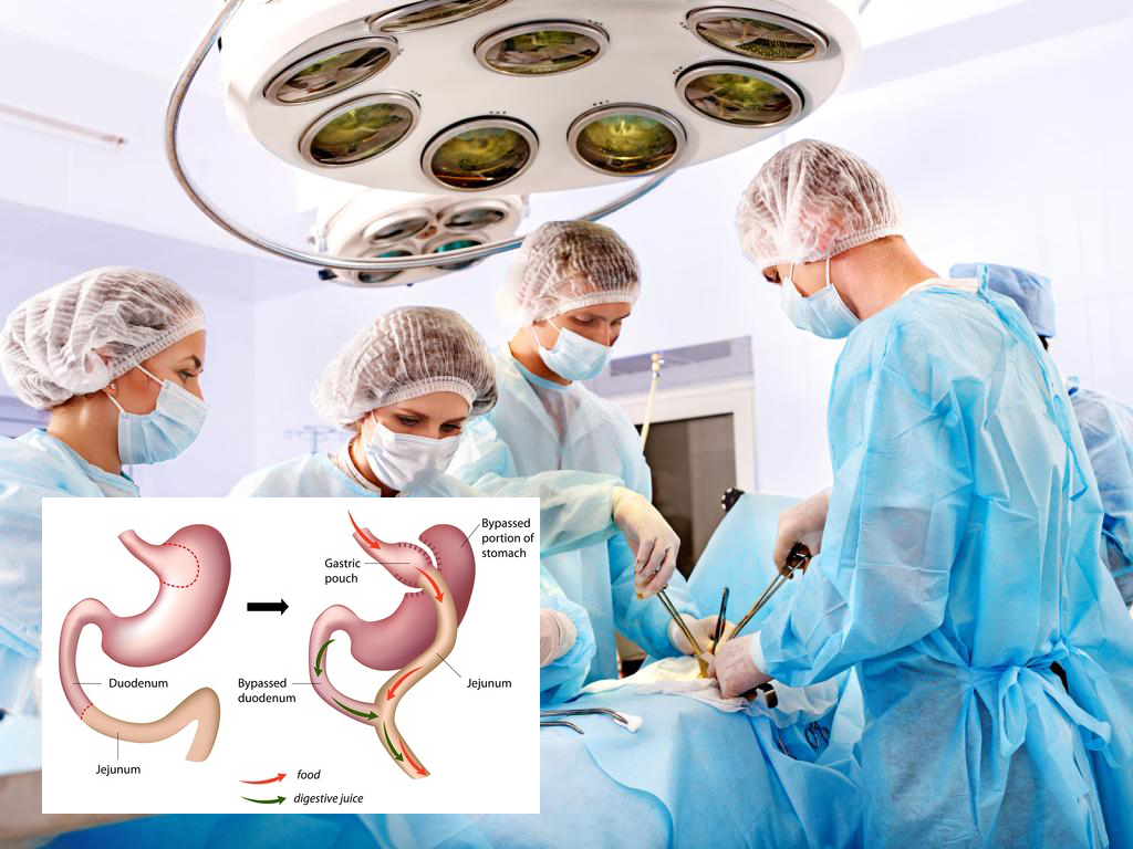 a case study on bariatric surgery